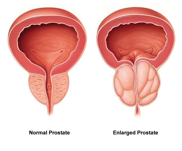 fluxactive-complete-prostate-health